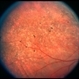 Congenital Nyctalopia